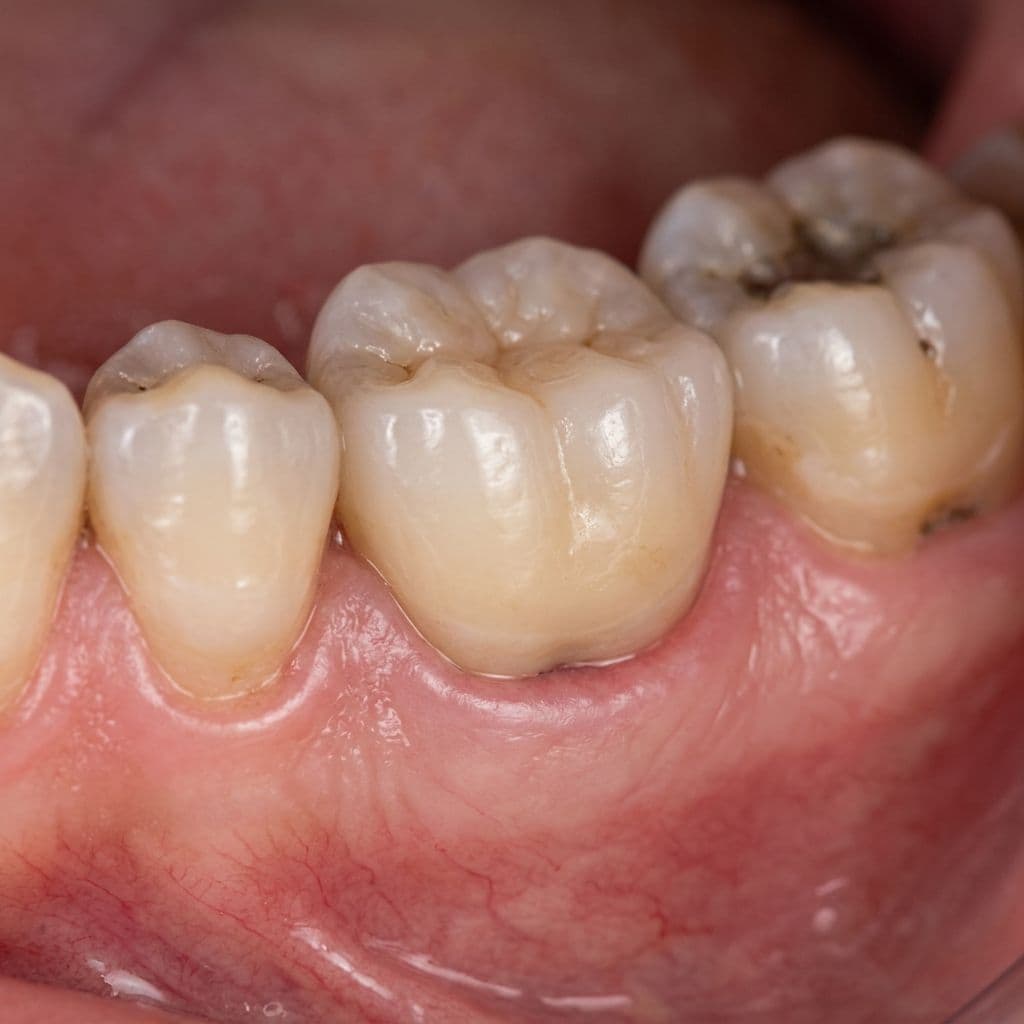 After — Dental Implant